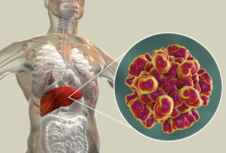  Hepatitis viral aguda de etiología desconocida